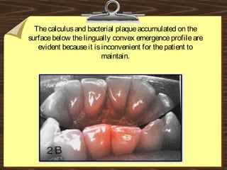 Thecalculusand bacterial plaqueaccumulated on the
surfacebelow thelingually convex emergenceprofileare
evident becauseit isinconvenient for thepatient to
maintain.
 