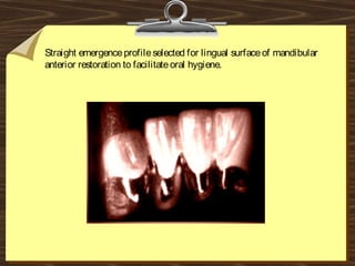 Straight emergenceprofileselected for lingual surfaceof mandibular
anterior restoration to facilitateoral hygiene.
 