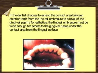 • If thedentist choosesto extend thecontact areabetween
anterior teeth from theincisal embrasureto alevel of the
gingival papillafor esthetics, thelingual embrasuremust be
wideenough for accessto thegingival tissueunder the
contact areafrom thelingual surface.
 