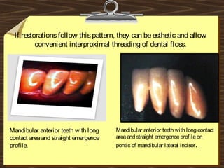 If restorationsfollow thispattern, they can beesthetic and allow
convenient interproximal threading of dental floss.
Mandibular anterior teeth with long
contact areaand straight emergence
profile.
Mandibular anterior teeth with long contact
areaand straight emergenceprofileon
pontic of mandibular lateral incisor.
 