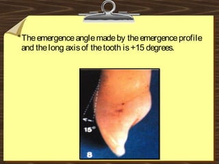 “Theemergenceanglemadeby theemergenceprofile
and thelong axisof thetooth is+15 degrees.
 