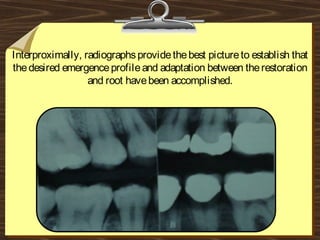 Interproximally, radiographsprovidethebest pictureto establish that
thedesired emergenceprofileand adaptation between therestoration
and root havebeen accomplished.
 