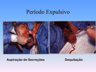 Período Expulsivo




Aspiração de Secreções    Dequitação
 