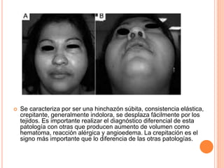  Se caracteriza por ser una hinchazón súbita, consistencia elástica,
crepitante, generalmente indolora, se desplaza fácilmente por los
tejidos. Es importante realizar el diagnóstico diferencial de esta
patología con otras que producen aumento de volumen como
hematoma, reacción alérgica y angioedema. La crepitación es el
signo más importante que lo diferencia de las otras patologías.
 