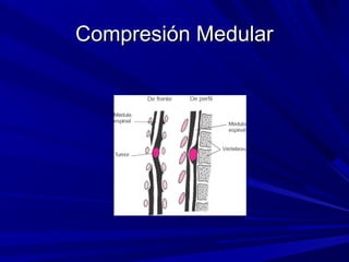 Compresión Medular
 
