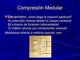 Compresión Medular
  Mecanismo: cómo llega al espacio epidural?
 A) extensión directa desde el cuerpo vertebral
 B) a través de foramen intervertebral
 C) infarto venoso por compromiso vascular
Metástasis directa a médula espinal: raro
 