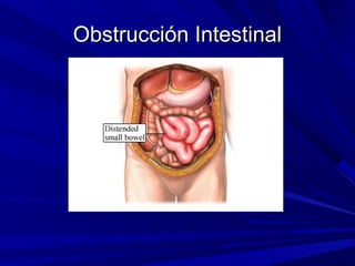 Obstrucción Intestinal
 