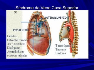 Síndrome de Vena Cava Superior
 