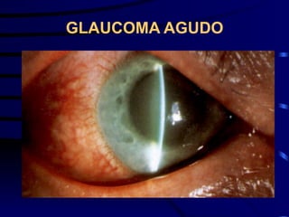 GLAUCOMA AGUDO
 