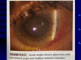 GLAUCOMA AGUDO
 