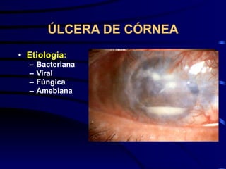 ÚLCERA DE CÓRNEA
• Etiologia:
– Bacteriana
– Viral
– Fúngica
– Amebiana
 