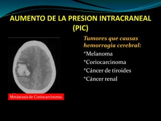 AUMENTO DE LA PRESION INTRACRANEAL
(PIC)
Tumores que causas
hemorragia cerebral:
*Melanoma
*Coriocarcin0ma
*Cáncer de tiro...