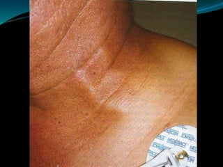 SINDROME DE VENA CAVA SUPERIOR
TAC de torax con contraste:
*Detalle anatómico
*Causa del síndrome
*Presencia de venas cola...