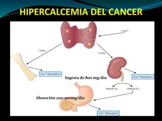 HIPERCALCEMIA DEL CANCER
Ingesta de 800 mg/día
Absorción 200-300mg/día
 