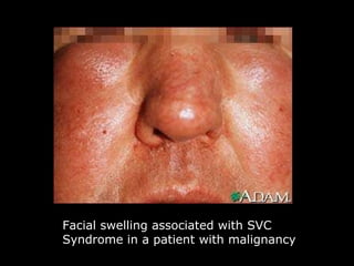 Facial swelling associated with SVC Syndrome in a patient with malignancy 