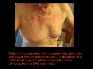 Patient who presented with progressively enlarging veins over the anterior chest wall.  A diagnosis of a right-sided super...