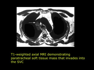 T1-weighted axial MRI demonstrating paratracheal soft tissue mass that invades into the SVC 