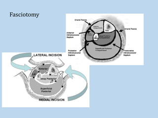 Fasciotomy
 
