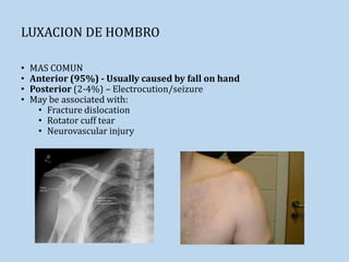 LUXACION DE HOMBRO
• MAS COMUN
• Anterior (95%) - Usually caused by fall on hand
• Posterior (2-4%) – Electrocution/seizure
• May be associated with:
• Fracture dislocation
• Rotator cuff tear
• Neurovascular injury
 