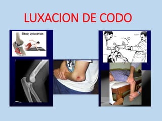LUXACION DE CODO
 
