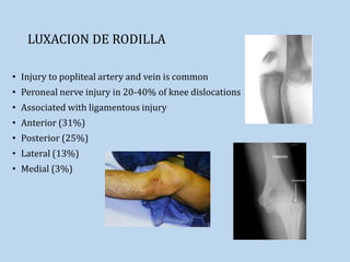 LUXACION DE RODILLA
• Injury to popliteal artery and vein is common
• Peroneal nerve injury in 20-40% of knee dislocations
• Associated with ligamentous injury
• Anterior (31%)
• Posterior (25%)
• Lateral (13%)
• Medial (3%)
 