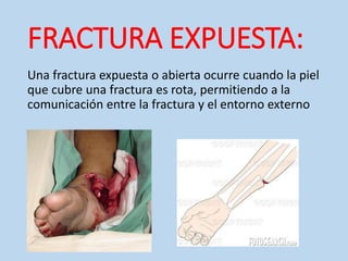 FRACTURA EXPUESTA:
Una fractura expuesta o abierta ocurre cuando la piel
que cubre una fractura es rota, permitiendo a la
comunicación entre la fractura y el entorno externo
 