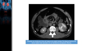 Paciente con herida por arma de fuego en la región lumbar. Se observa fractura del
tercio medio renal asociada con un hematoma subcapsular (flecha).
 
