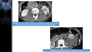 Grado I: Contusión renal y hematoma subcapsular en paciente de 16 años
Zonas de menor realce interpolar y lesión en arco de baja densidad
Grado II: Hematoma perirrenal en mujer de 37 años
 