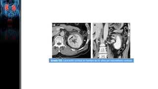 Grado III: Laceración cortical en hombre de 61 años por traumatismo contuso
 