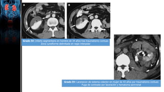 Grado IV: Infarto segmentario en hombre de 34 años tras traumatismo contuso
Zona cuneiforme delimitada en regio interpolar
Grado IV: Laceracion de sistema colector en mujer de 43 años por traumatismo contuso
Fuga de contraste por laceración y hematoma perirrenal
 