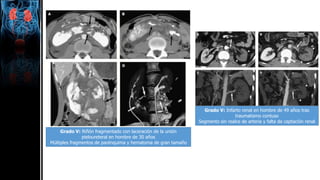 Grado V: Riñón fragmentado con laceración de la unión
pieloureteral en hombre de 30 años
Múltiples fragmentos de parénquima y hematoma de gran tamaño
Grado V: Infarto renal en hombre de 49 años tras
traumatismo contuso
Segmento sin realce de arteria y falta de captación renal
 
