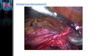 Ureteroureterostomía
 