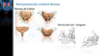 Reimplantación ureteral directa
Técnica de Cohen
Técnica de Lich - Gregoire
 