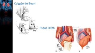 Psoas Hitch
Colgajo de Boari
 