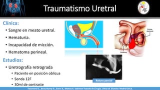 Traumatismo Uretral
Sabinston
Clínica:
• Sangre en meato uretral.
• Hematuria.
• Incapacidad de micción.
• Hematoma perineal.
Estudios:
• Uretrografía retrograda
• Paciente en posición oblicua
• Sonda 12F
• 30ml de contraste
Rotura parcial
Twonsend C., Beauchamp D., Evers B., Mattox K. Sabiston Tratado de Cirugía. 19na ed. Elsevier. Madrid 2013.
 