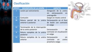 Clasificación
GRADO DESCRIPCIÓN DE LA LESIÓN ASPECTO
I Lesión por estiramiento Elongación de la uretra
sin extravasación en
uretrografía
II Contusión Sangre en meato uretral
III Rotura parcial de la uretra
anterior o posterior
Extravasación en el foco
de lesión con contraste
en vejiga
IV Terminación de la interrupción
de la uretra posterior Extravasación de
contraste sin visualización
en vejiga
V Rotura completa de la uretra
posterior
VI Rotura completa de la uretra
anterior
Extravasación sin
contraste en uretra
proximal o vejiga
 