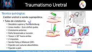 Traumatismo Uretral
Sabinston
Técnica quirúrgica:
Catéter uretral o sonda suprapúbica.
• Tubo de cistotomía
• Decúbito supino y Trendelenburg.
• Línea media – 2cm sínfisis pubis
• Cistotomía anterior.
• Paño fenestrado e incisión
• Trocar n 30° hacia arriba.
• 2 impulsos.
• Sonda Foley o Malecot 24Fr.
• Fijación con suturas absorbibles.
• Fijación a piel.
Twonsend C., Beauchamp D., Evers B., Mattox K. Sabiston Tratado de Cirugía. 19na ed. Elsevier. Madrid 2013.
 