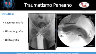 Traumatismo Peneano
Sabinston
Estudios:
• Cavernosografía
• Ultrasonografía
• Uretrografía
Twonsend C., Beauchamp D., Evers B., Mattox K. Sabiston Tratado de Cirugía. 19na ed. Elsevier. Madrid 2013.
 