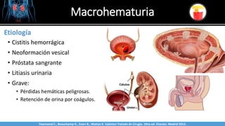Macrohematuria
Sabinston
Etiología
• Cistitis hemorrágica
• Neoformación vesical
• Próstata sangrante
• Litiasis urinaria
• Grave:
• Pérdidas hemáticas peligrosas.
• Retención de orina por coágulos.
Twonsend C., Beauchamp D., Evers B., Mattox K. Sabiston Tratado de Cirugía. 19na ed. Elsevier. Madrid 2013.
 
