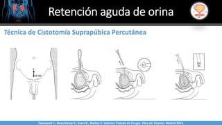 Sabinston
Técnica de Cistotomía Suprapúbica Percutánea
Retención aguda de orina
Twonsend C., Beauchamp D., Evers B., Mattox K. Sabiston Tratado de Cirugía. 19na ed. Elsevier. Madrid 2013.
 