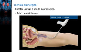 Técnica quirúrgica:
Catéter uretral o sonda suprapúbica.
• Tubo de cistotomía
 