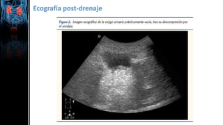 Ecografía post-drenaje
 
