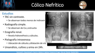 Cólico Nefrítico
Sabinston
Estudios
• TAC sin contraste.
• Se observan todos menos de indinavir
• Radiografía simple.
• Se observan de Ca y estruvita
• Ecografía renal.
• Revela hidronefrosis y cálculos.
• Pielografía intravenosa
• Ubicación de cálculo y dilatación de vía.
• Uroanálisis, cultivo y orina en 24h.
Twonsend C., Beauchamp D., Evers B., Mattox K. Sabiston Tratado de Cirugía. 19na ed. Elsevier. Madrid 2013.
 