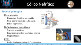 Cólico Nefrítico
Sabinston
Técnica quirúrgica
• Ureteroscopia:
• Dispositivo flexible o semirrígido.
• Fibra laser a través de endoscopio.
• Extrae fragmentos.
• Nefrolitotomía percutánea:
• Trayecto percutáneo
• Endoscopio grande y fuentes de energía
• Fragmentación
• ESWL:
• Ondas de choque bajo guía fluoroscópica.
Twonsend C., Beauchamp D., Evers B., Mattox K. Sabiston Tratado de Cirugía. 19na ed. Elsevier. Madrid 2013.
 