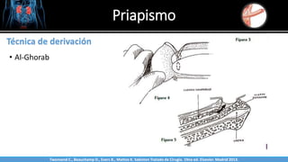 Priapismo
Sabinston
Técnica de derivación
• Al-Ghorab
Twonsend C., Beauchamp D., Evers B., Mattox K. Sabiston Tratado de Cirugía. 19na ed. Elsevier. Madrid 2013.
 