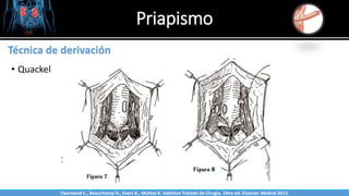 Priapismo
Sabinston
Técnica de derivación
• Quackel
Twonsend C., Beauchamp D., Evers B., Mattox K. Sabiston Tratado de Cirugía. 19na ed. Elsevier. Madrid 2013.
 