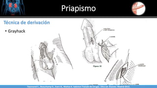 Priapismo
Sabinston
Técnica de derivación
• Grayhack
Twonsend C., Beauchamp D., Evers B., Mattox K. Sabiston Tratado de Cirugía. 19na ed. Elsevier. Madrid 2013.
 