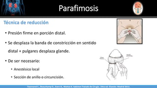 Parafimosis
Sabinston
Técnica de reducción
• Presión firme en porción distal.
• Se desplaza la banda de constricción en sentido
distal + pulgares desplaza glande.
• De ser necesario:
• Anestésico local
• Sección de anillo o circuncisión.
Twonsend C., Beauchamp D., Evers B., Mattox K. Sabiston Tratado de Cirugía. 19na ed. Elsevier. Madrid 2013.
 