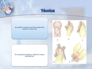 Se prefiere: Incisión en la línea media Para
exponer un bazo roto
En la resección selectiva: Utilizar la incisión
subcostal izq.
Técnica
 