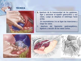 1. Apertura de la transcavidad de los epiplones,
ligar y seccionar el epiplón gastrocólico y sus
vasos. Luego se desplaza el estómago hacia
arriba
En traumatismos 1ro se ligan las inserciones y
luego los vasos.
2. Apertura del ligamento gastroesplénico,
ligadura y sección de los vasos cortos.
TÉCNICA
 